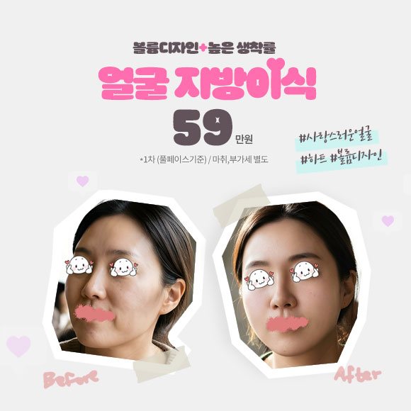 얼굴지방이식 59만원