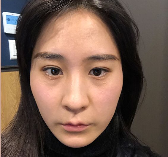 Real 사례 2 Before
