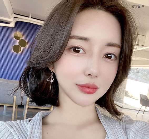 Real 사례 4 After(3개월 후)
