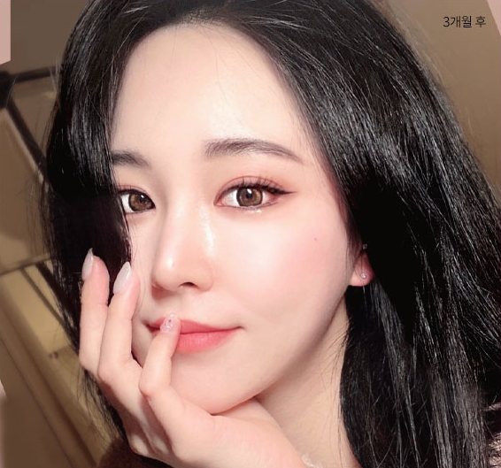 Real 사례 5 After(3개월 후)